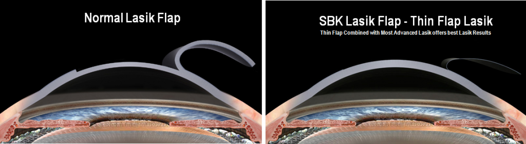 SBK Lasik Laser Eye Surgery in Delhi